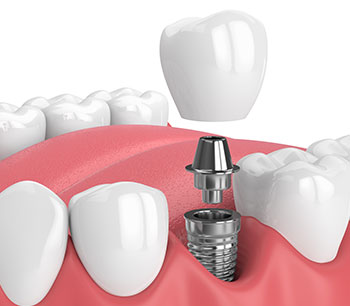 Dental Implants Overseas – What Could Go Wrong?